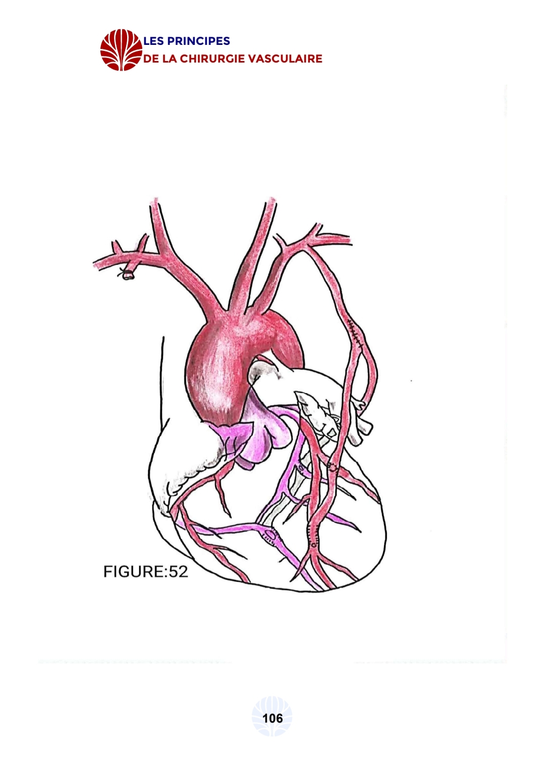 Les principes de la chirurgie vasculaire - الصورة 18
